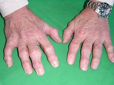 arthrosis vun de Fanger