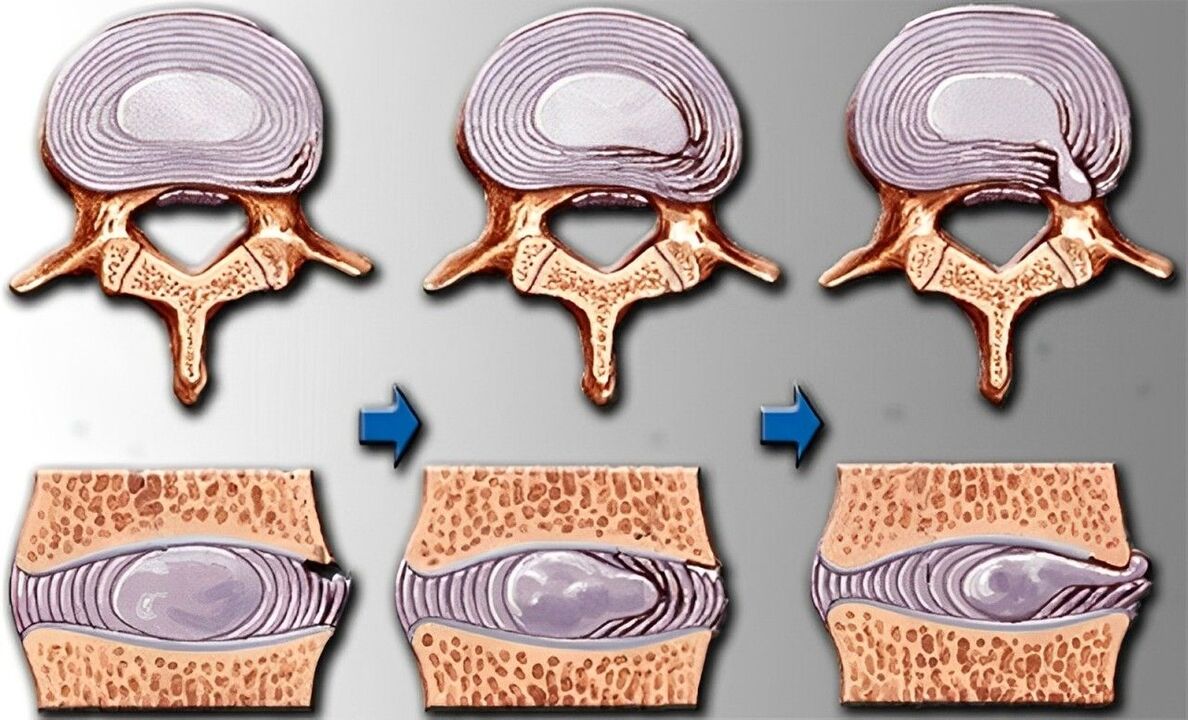 Etappe vun osteochondrosis