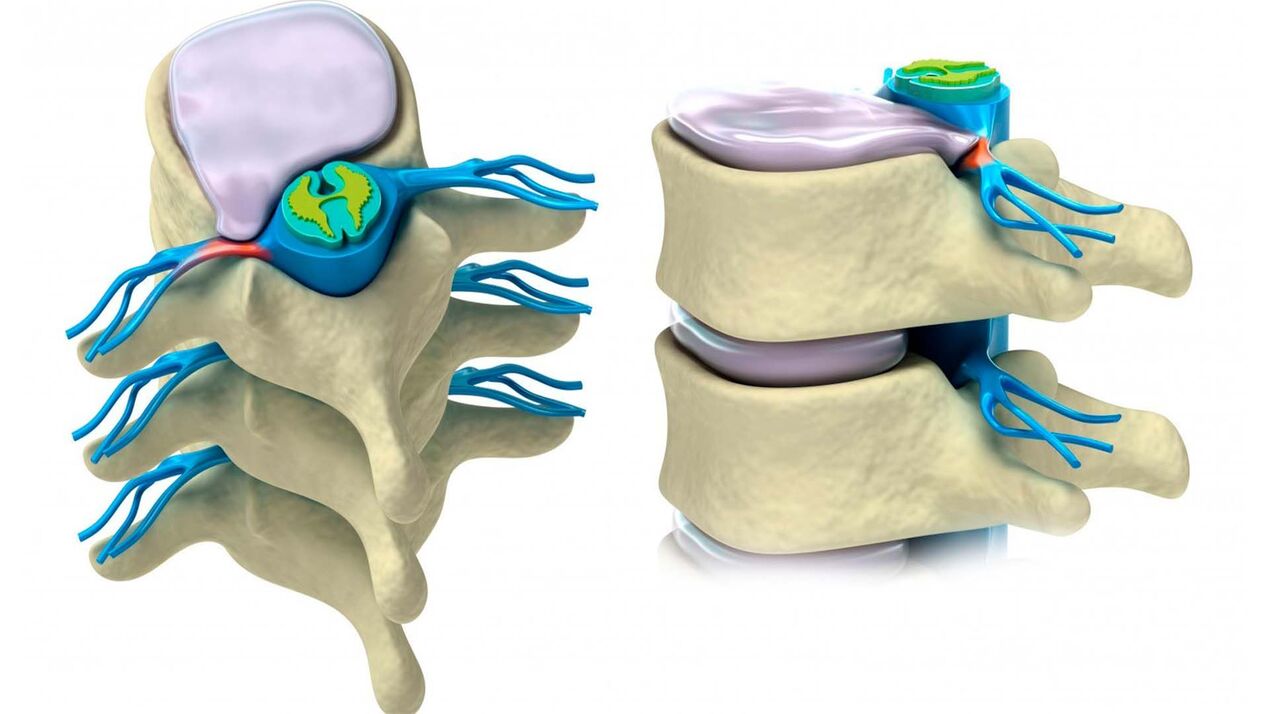 beschiedegt Spinal Disc