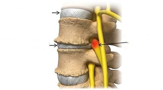 Spinal Diskprobleemer