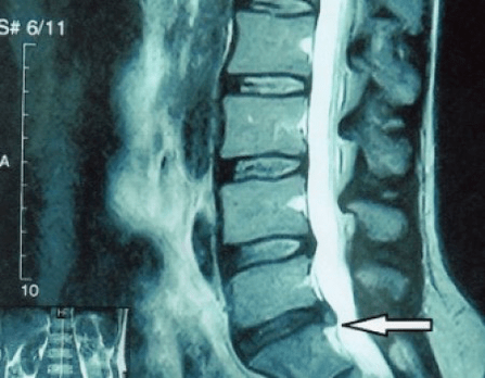 Protrusioun vun enger Spinal Disc op engem MRI Scan