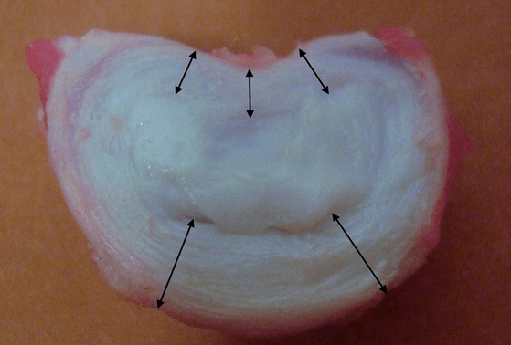 wéi gesäit eng intervertebral Scheif aus