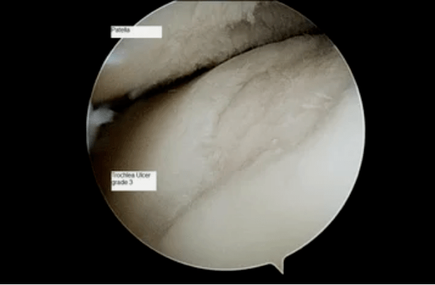 Astroskop Vue vun engem Kniegelenk mat Arthrosis vum 3. Grad