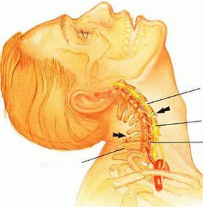 Osteochondrose vun der cervical Wirbelsäule